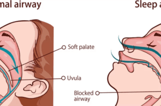 Diagram of a normal airway (left) vs airway with obstructive sleep apnea (right) sleep apnea dentist in Poquoson Virginia