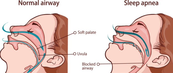 Diagram of a normal airway (left) vs airway with obstructive sleep apnea (right) sleep apnea dentist in Poquoson Virginia